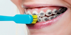 رعایت بهداشت دهان و دندان حین درمان ارتودنسی چگونه است؟